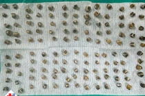 Viêm túi mật cấp đe dọa tính mạng vì 130 viên sỏi trong túi mật 