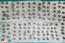 Viêm túi mật cấp đe dọa tính mạng vì 130 viên sỏi trong túi mật 