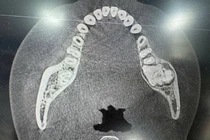 View - Cẩn thận nang xương hàm gây biến dạng mặt | Báo Tri thức và Cuộc sống - TIN TỨC PHỔ BIẾN KIẾN THỨC 24H