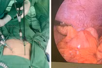 Viêm ruột thừa dưới gan thường gây nhầm lẫn với các bệnh lý gan mật, dạ dày