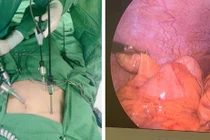 Viêm ruột thừa dưới gan thường gây nhầm lẫn với các bệnh lý gan mật, dạ dày