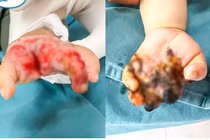 Cứu bàn tay hoại tử cho trẻ 8 tháng tuổi bị tai nạn máy tuốt lúa