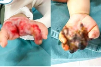 Cứu bàn tay hoại tử cho trẻ 8 tháng tuổi bị tai nạn máy tuốt lúa