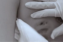 Cấp cứu lấy mô hoại tử cho cô gái áp xe nặng sau tiêm filler nâng vòng một