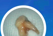 Nhổ răng tại phòng khám tư, răng rơi vào phế quản trẻ 8 tuổi