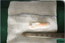 Lối sống sai hại người trẻ tuổi thoát vị đĩa đệm nguy cơ liệt