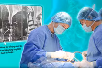 Hẹp ống sống dễ liệt vận động cần giải ép sớm