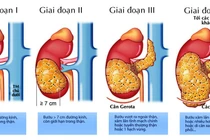 Ung thư thận gia tăng đáng báo động ở người trẻ