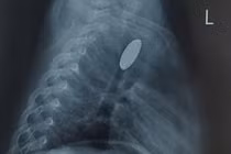 Nghỉ hè, 8 trẻ nuốt dị vật đường tiêu hóa