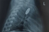 Nghỉ hè, 8 trẻ nuốt dị vật đường tiêu hóa