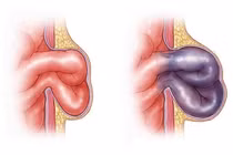 Thoát vị bẹn nghẹt, cẩn trọng tránh biến chứng nguy hiểm