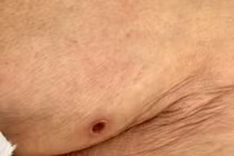 Bệnh nhân 81 tuổi viêm phổi, tổn thương gan vì sốt mò