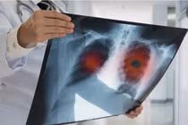 10-25% người bị ung thư phổi chưa từng hút thuốc