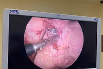 Nhịn tiểu dễ vỡ bàng quang tự phát biến chứng nguy hiểm