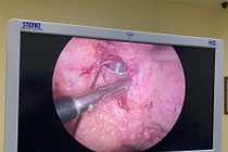 Nhịn tiểu dễ vỡ bàng quang tự phát biến chứng nguy hiểm