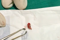 Hiếm gặp nang rò sống mũi gây viêm màng não, áp xe nội sọ