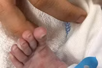 Một ca bệnh giang mai sơ sinh khiến bác sĩ day dứt