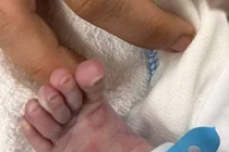 Một ca bệnh giang mai sơ sinh khiến bác sĩ day dứt