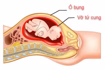 Sản phụ 23 tuổi vỡ tử cung nguy kịch vì ngại khám thai