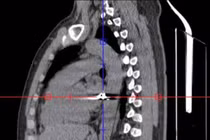 Người đàn ông Đồng Nai bị đạn bắn xuyên ngực được cứu sống ngoạn mục