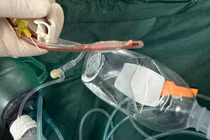 Bé gái 3 tuổi ở TP HCM tử vong sau khi sặc thức ăn ở lớp, bác sĩ cảnh báo