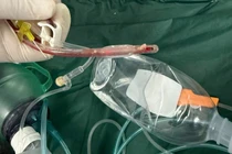 Bé gái 3 tuổi ở TP HCM tử vong sau khi sặc thức ăn ở lớp, bác sĩ cảnh báo