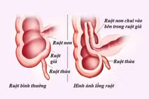 Trẻ khóc bất thường cẩn thận lồng ruột nguy hiểm