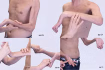 Cách điều trị liệt đám rối thần kinh cánh tay