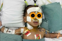 Tuần hoàn ngoài cơ thể cứu trẻ 8kg viêm phổi nặng do Adenovirus 