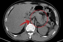 Lạm dụng rượu bia, người đàn ông 47 tuổi viêm tụy cấp