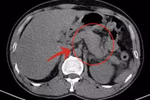 Lạm dụng rượu bia, người đàn ông 47 tuổi viêm tụy cấp
