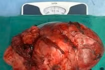 Lấy u GIST đại tràng nặng 5kg choáng hết ổ bụng người đàn ông ở Thanh Hóa