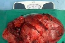 Lấy u GIST đại tràng nặng 5kg choáng hết ổ bụng người đàn ông ở Thanh Hóa