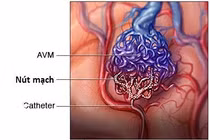 Địa chỉ vàng: Bệnh viện Hà Nội can thiệp dị dạng mạch máu