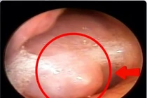U "ẩn nấp" trong mũi khiến cụ ông nghẹt mũi chảy dịch nhiều năm