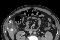 Người đàn ông 58 tuổi áp xe gan vì nuốt phải xương cá
