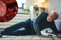 Nguy cơ chảy máu do chấn thương khi dùng thuốc chống huyết khối