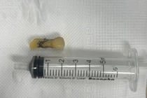 Nội soi gắp dị vật trong phế quản gốc của bệnh nhân