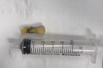 Nội soi gắp dị vật trong phế quản gốc của bệnh nhân