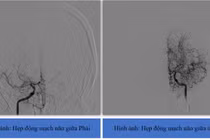 Liệt nửa người do nhồi máu não Moyamoya hiếm gặp