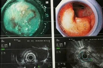 Người đàn ông cùng lúc phát hiện mắc hai bệnh ung thư