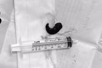 Gắp thành công dị vật sống 3 tháng trong khí quản bệnh nhân