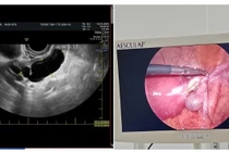 Người phụ nữ 47 tuổi nguy kịch vì đau bụng do ứ mủ vòi trứng