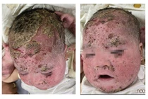 Cảnh giác biến chứng nặng do điều trị viêm da cơ địa, viêm da đầu sai cách 