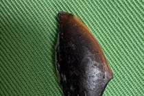 Viêm phổi kéo dài do hạt hồng xiêm mắc sâu ở thùy dưới phổi phải