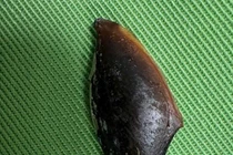 Viêm phổi kéo dài do hạt hồng xiêm mắc sâu ở thùy dưới phổi phải