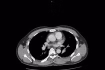 Đau hông lưng, tiểu gắt, bệnh nhân 34 tuổi nguy kịch vì thận ứ mủ