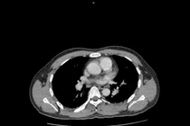 Đau hông lưng, tiểu gắt, bệnh nhân 34 tuổi nguy kịch vì thận ứ mủ
