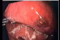 Sốt cao vi khuẩn tấn công thực quản gây suy đa tạng, sốc nhiễm khuẩn