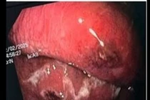 Sốt cao vi khuẩn tấn công thực quản gây suy đa tạng, sốc nhiễm khuẩn